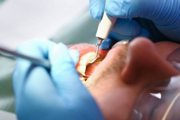 Best Emergency Root Canal Treatment in Paris, TX